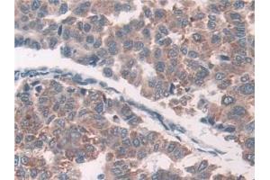 Detection of Grb10 in Human Liver cancer Tissue using Polyclonal Antibody to Growth Factor Receptor Bound Protein 10 (Grb10)