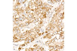 Immunohistochemistry of paraffin-embedded human liver cancer using PFKP antibody (ABIN7269309) at dilution of 1:100 (40x lens). (PFKP anticorps)