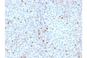 IHC testing of FFPE human bladder carcinoma with Topoisomerase II alpha antibody (clone TOP2A/1361). (Topoisomerase II alpha anticorps  (AA 1352-1493))