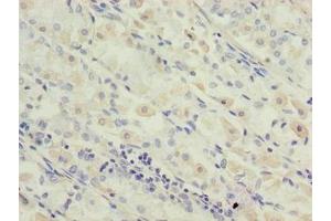 Immunohistochemistry of paraffin-embedded human gastric cancer using ABIN7142334 at dilution of 1:100 (OXSM anticorps  (AA 78-345))