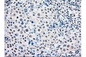 Immunohistochemical staining of paraffin-embedded Adenocarcinoma of ovary tissue using anti-MAPK1mouse monoclonal antibody. (ERK2 anticorps)