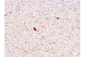 Formalin-fixed, paraffin-embedded human Brain stained with Serum Amyloid P Mouse Monoclonal Antibody (APCS/3240). (APCS anticorps  (AA 143-223))
