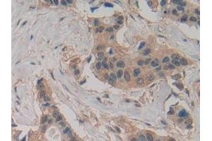 Detection of Slit2 in Human Breast cancer Tissue using Polyclonal Antibody to Slit Homolog 2 (Slit2) (SLIT2 anticorps  (AA 1416-1528))