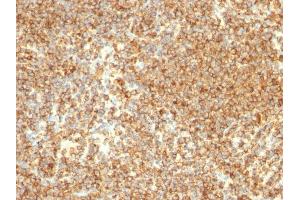Formalin-fixed, paraffin-embedded human Lymphoma stained with CD20 Mouse Monoclonal Antibody (L26). (CD20 anticorps)