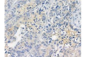 ABIN6256802 and ABIN6267299 at 1/100 staining human lung squamous cell carcinoma by IHC-P. (Integrin beta 3 anticorps  (pTyr773))
