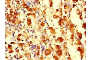Immunohistochemistry of paraffin-embedded human melanoma using ABIN7163108 at dilution of 1:100