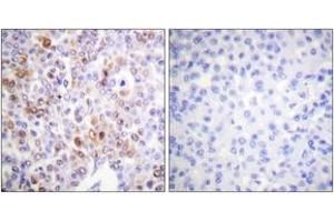 Immunohistochemistry analysis of paraffin-embedded human breast carcinoma tissue, using Histone H4 (Acetyl-Lys16) Antibody. (Histone H4 anticorps  (acLys16))