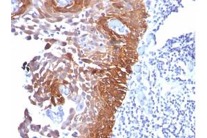 Formalin-fixed, paraffin-embedded human Cervical Carcinoma stained with CK17 Mouse Monoclonal Antibody (E3). (KRT17 anticorps)