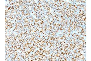 Formalin-fixed, paraffin-embedded human Mantle Cell Lymphoma stained with Cyclin D1 Mouse Monoclonal Antibody (DCS-6).