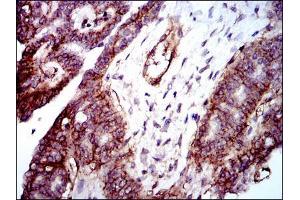 Immunohistochemical analysis of paraffin-embedded ovarian cancer tissues using ITGB1 mouse mAb with DAB staining.