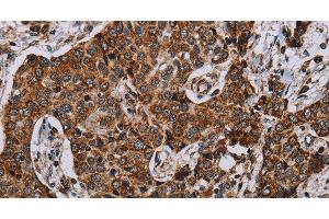 Immunohistochemistry of paraffin-embedded Human liver cancer using NDUFA4 Polyclonal Antibody at dilution of 1:40 (NDUFA4 anticorps)