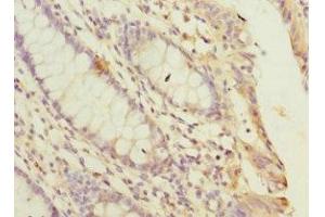 Immunohistochemistry of paraffin-embedded human colon cancer using ABIN7169258 at dilution of 1:100 (PPP2R5C anticorps  (Regulatory Subunit Gamma))
