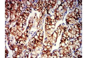 Immunohistochemical analysis of paraffin-embedded renal cancer tissues using CD203C mouse mAb with DAB staining. (ENPP3 anticorps  (AA 45-163))