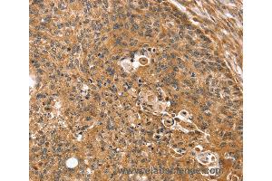 Immunohistochemistry of Human breast cancer using SSX2IP Polyclonal Antibody at dilution of 1:35