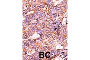Formalin-fixed and paraffin-embedded human cancer tissue reacted with the primary antibody, which was peroxidase-conjugated to the secondary antibody, followed by AEC staining.