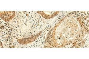 Immunohistochemistry of paraffin-embedded Human esophagus cancer tissue using ARL4D Polyclonal Antibody at dilution of 1:50(x200) (ARL4D anticorps)