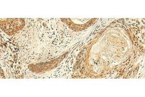 Immunohistochemistry of paraffin-embedded Human esophagus cancer tissue using ARL4D Polyclonal Antibody at dilution of 1:50(x200) (ARL4D anticorps)