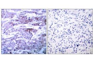 Immunohistochemical analysis of paraffin- embedded human breast carcinoma tissue using BAD (Ab-112) antibody (E021062). (BAD anticorps)