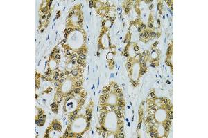 Immunohistochemistry of paraffin-embedded human rectal cancer using RPS7 antibody. (RPS7 anticorps)