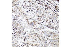 Immunohistochemistry of paraffin-embedded human esophageal cancer using MCT4/SLC16 Rabbit pAb (ABIN6129472, ABIN6147859, ABIN6147860 and ABIN6214836) at dilution of 1:100 (40x lens).