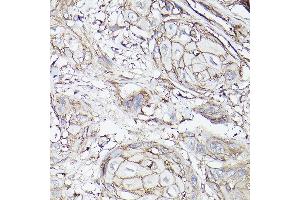 Immunohistochemistry of paraffin-embedded human esophageal cancer using MCT4/SLC16 Rabbit pAb (ABIN6129472, ABIN6147859, ABIN6147860 and ABIN6214836) at dilution of 1:100 (40x lens). (SLC16A3 anticorps  (AA 371-465))
