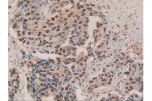IHC-P analysis of Human Breast Cancer Tissue, with DAB staining. (HDGF anticorps  (AA 10-240))