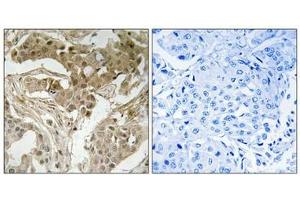 Immunohistochemical analysis of paraffin-embedded human breast carcinoma tissue using FOS (Phospho-Thr232) antibody (left)or the same antibody preincubated with blocking peptide (right). (c-FOS anticorps  (pThr232))