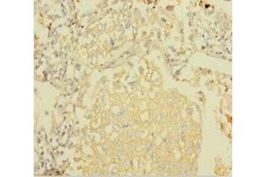 Immunohistochemistry of paraffin-embedded human lung cancer using ABIN7160909 at dilution of 1:100 (NDUFA6 anticorps  (AA 27-154))
