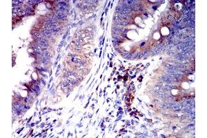 Immunohistochemical analysis of paraffin-embedded rectum cancer tissues using CD327 mouse mAb with DAB staining. (SIGLEC6 anticorps  (AA 27-347))
