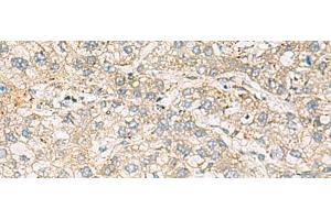 Immunohistochemistry of paraffin-embedded Human liver cancer tissue using LRRC28 Polyclonal Antibody at dilution of 1:60(x200) (LRRC28 anticorps)