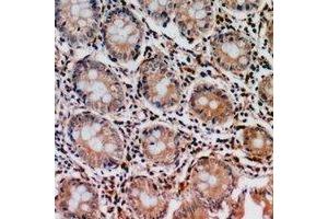 Immunohistochemical analysis of PIR121 staining in human colon cancer formalin fixed paraffin embedded tissue section. (CYFIP2 anticorps  (C-Term))