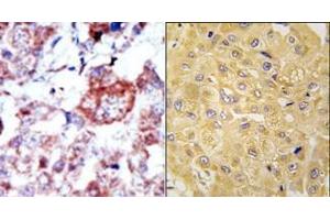 (LEFT)Formalin-fixed and paraffin-embedded human cancer tissue reacted with the primary antibody, which was peroxidase-conjugated to the secondary antibody, followed by AEC staining. (ILK anticorps  (N-Term))