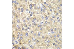 Immunohistochemistry of paraffin-embedded human liver cancer using HADH antibody. (HADH anticorps  (AA 1-314))