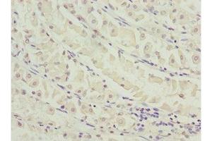 Immunohistochemistry of paraffin-embedded human gastric cancer using ABIN7155798 at dilution of 1:100