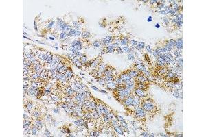 Immunohistochemistry of paraffin-embedded Human gastric cancer using PDYN Polyclonal Antibody at dilution of 1:100 (40x lens). (PDYN anticorps)