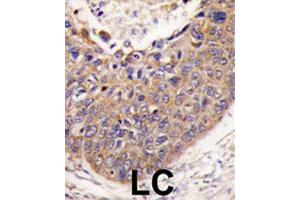 Formalin-fixed and paraffin-embedded human lung carcinoma tissue reacted with FXN polyclonal antibody  , which was peroxidase-conjugated to the secondary antibody, followed by DAB staining.