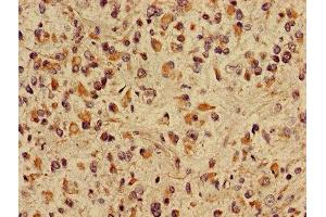 Immunohistochemistry of paraffin-embedded human glioma using ABIN7149048 at dilution of 1:100 (CRIPT anticorps  (AA 1-101))