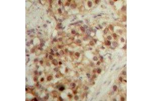 Immunohistochemical analysis of LONP2 staining in human breast cancer formalin fixed paraffin embedded tissue section. (LONP2 anticorps  (C-Term))