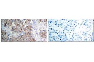Immunohistochemical analysis of paraffin- embedded human breast carcinoma tissue using IGF-1R (phospho-Tyr1161) antibody (E011087). (IGF1R anticorps  (pTyr1161))