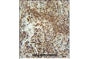 ZN Antibody (Center) (ABIN654509 and ABIN2844236) immunohistochemistry analysis in formalin fixed and paraffin embedded human lung carcinoma followed by peroxidase conjugation of the secondary antibody and DAB staining. (ZNF667 anticorps  (AA 303-331))