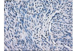 Immunohistochemical staining of paraffin-embedded endometrium tissue using anti-BCKDK mouse monoclonal antibody. (BCKDK anticorps)
