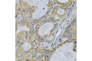 Immunohistochemistry of paraffin-embedded human thyroid cancer using TLR7 Antibody (ABIN1875113) at dilution of 1:100 (40x lens).