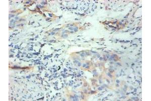Immunohistochemical of paraffin-embedded human breast cancer tissue using ABIN7152614 at dilution of 1:200