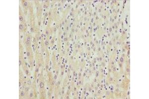 Immunohistochemistry of paraffin-embedded human liver cancer using ABIN7149264 at dilution of 1:100