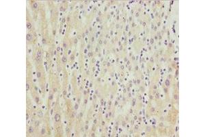 Immunohistochemistry of paraffin-embedded human liver cancer using ABIN7149264 at dilution of 1:100 (CYP3A4 anticorps  (AA 244-503))