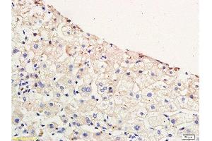 Formalin-fixed and paraffin embedded human hepatitides tissue labeled with Anti-CCR4 Polyclonal Antibody, Unconjugated  at 1:200 followed by conjugation to the secondary antibody and DAB staining