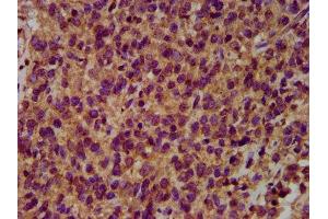 IHC image of ABIN7151037 diluted at 1:500 and staining in paraffin-embedded human glioma performed on a Leica BondTM system. (HECW2 anticorps  (AA 495-641))