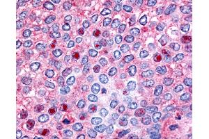 Anti-HNF4G / HNF4 Gamma antibody IHC of human Breast, Carcinoma. (HNF4 gamma anticorps  (Ligand Binding Domain))