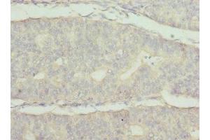 Immunohistochemistry of paraffin-embedded human endometrial cancer using ABIN7174024 at dilution of 1:100 (FRK anticorps  (AA 1-220))