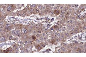 ABIN6276422 at 1/100 staining Human liver cancer tissue by IHC-P. (CEACAM5 anticorps  (Internal Region))